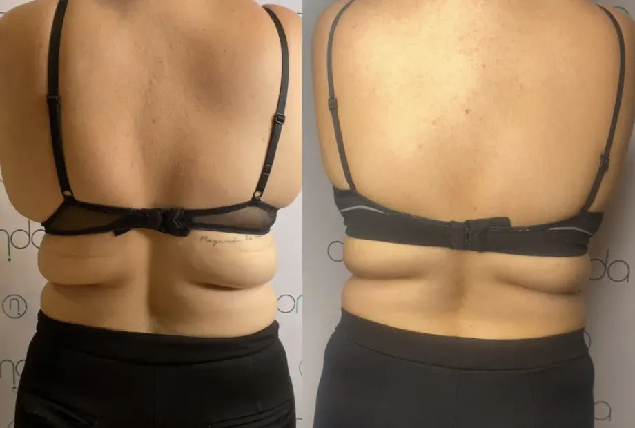 Onda body contouring back fat before and after at Ora Skin
